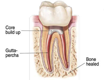 afterrootcanal